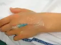 Ein Zugang am Handrücken, wo tut ein zugang am wenigsten weh? Hier wird ein Infusionsschlauch an einer Hand befestigt.