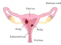 Schemat budowy macicy z widocznymi polipami. Endometrium jest cienkie, co może utrudniać implantację.