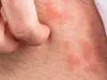 Haut mit roten Flecken und Haaren, die von einem Finger gekratzt werden. Backpulver gegen Juckreiz könnte Linderung verschaffen.