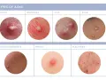 Close-up images show various types of acne, including pustules, whiteheads, cysts, milia, closed comedones, papules, and blackheads. Some show small white bumps on the face.