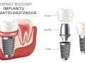 Schemat budowy implantu stomatologicznego: korona, łącznik i śruba.