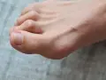 Palce młotkowate na stopie, widoczne z bliska na szarym tle.