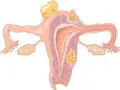 Anatomical illustration of a uterus with fibroids. Warto wiedzieć, ile cm ma macica, by monitorować jej stan.