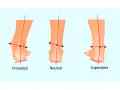 Illustrazione che mostra la pronazione e supinazione del piede: pronato, neutro e supinato, con linee rosse che indicano l'allineamento.