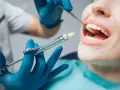 Dentysta podaje znieczulenie, by leki przeciwbólowe zadziałały przed zabiegiem. Pacjentka ma otwarte usta, a w nich widać narzędzia stomatologiczne.