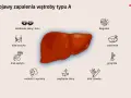 Objawy zapalenia wątroby typu A: zażółcenie skóry, bóle brzucha, brak apetytu, nudności, biegunka, osłabienie, gorączka, bóle stawów, swędzenie skóry.