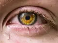 Occhio con iride dorata, palpebre arrossate e lacrime che scendono, sintomo di occhio secco grave.