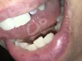Lingua con afte dolorose. Le lesioni biancastre e rosse sono visibili sulla superficie della lingua, circondate da un alone infiammato.
