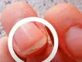 Gros plan sur un ongle qui se dédouble, montrant les couches séparées. Comprendre pourquoi les ongles se dédoublent peut aider à prévenir ce problème.