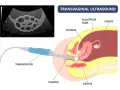 Transvaginaler Ultraschall zur Diagnose von Endometriose. Ein Ultraschallkopf wird in die Vagina eingeführt, um Gebärmutter, Eierstöcke und Eileiter abzubilden.