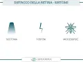 Distacco retina: scotoma (ombra), fosfeni (lampi) e miodesopsie (mosche volanti) sono sintomi da non sottovalutare.