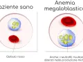Confronto tra globuli rossi e neutrofili di un paziente sano e uno con anemia megaloblastica, dove i neutrofili appaiono alterati.