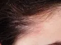 Nahaufnahme der Kopfhaut mit roten, schuppigen Stellen und feinen Haaren. Dies deutet auf Schuppenflechte am Kopfhautrand hin, die auch Haarausfall verursachen kann.