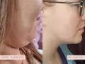 Przed i po zabiegu lipolizy podbródka. Widoczna redukcja tkanki tłuszczowej, wyraźniejsza linia żuchwy.