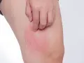 Rote, juckende Stelle am Bein, ein mögliches Symptom von Diabetes haut.