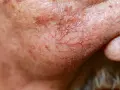 Couperose-Kosmetik: So beruhigen Sie rote Äderchen wirklich