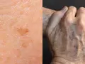 Nahaufnahme von Haut mit Pigmentflecken, Falten und Altersflecken. Retinol gegen Pigmentflecken kann helfen, das Hautbild zu verbessern.
