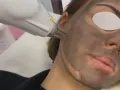 Zabieg laserowy na twarz z maską węglową. Skóra przygotowana do peelingu węglowego.