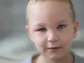 Mały chłopiec z niebieskimi oczami, u którego widoczne jest spuchnięte oko.