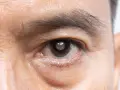 Occhio con opacità del cristallino (pseudofachia) e segni di possibile distacco retina.