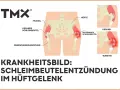 Illustration zeigt das Hüftgelenk mit gesunden und entzündeten Schleimbeuteln. Bursitis trochanterica als Krankheitsbild.