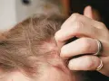 Juckende Kopfhaut mit Rötungen und Schuppen, die auf Neurodermitis hindeuten und zu Haarausfall führen können.