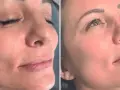 Vorher-nachher Vergleich: Ein raucher gesicht mit Falten wird glatter und jugendlicher.