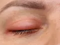 Ojo hinchado al despertar, con enrojecimiento e irritación en el párpado.