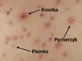 Skóra z licznymi zmianami: plamkami, krostkami i pęcherzykami, typowymi objawami ospy wietrznej.