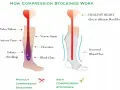 Diagram shows how compression stockings help with inflammation by improving blood flow, preventing issues like edema and varicose veins.