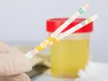 Rękawiczka trzyma paski testowe do analizy moczu, obok pojemnika z żółtym płynem. Kolory pasków sugerują badanie kwas moczowy norma.