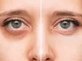 Avant/après : correction des cernes grâce à la colorimétrie et au maquillage.