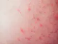 Pryszcze w miejscach intymnych – przyczyny, objawy i co robić?