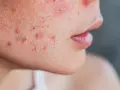 Primer plano de una mejilla con acné, mostrando cómo quitar granos de la cara para una piel más clara.