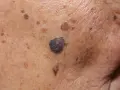 Zbliżenie na skórę z licznymi brązowymi plamami i pieprzykami, w tym jeden większy, ciemny i nierówny.