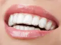 Zbliżenie na usta z widocznym aparatem Invisalign, który dyskretnie koryguje zgryz.