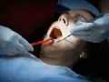Dentysta bada usta pacjentki, która cierpi na ropień zęba. Widoczne narzędzia stomatologiczne i rozwierak.
