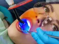 Zabieg malowania zębów światłem UV. Dentysta utwardza materiał, by uzyskać piękny uśmiech.