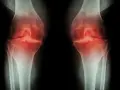RTG kolan z zaznaczoną osteofitami i zwężeniem szpary stawowej, sugerujące chorobę zwyrodnieniową. Może być wskazana osteotomia podkolanowa.