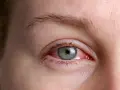 Occhio arrossato e irritato, possibile infezione oculare. Il nome di questa condizione è congiuntivite.