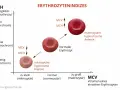 Diagramm zeigt Erythrozytenindizes: MCH (Hämoglobin pro Erythrozyt) und MCV (Volumen). Mikrozytäre, hypochrome Anämie bei niedrigem MCH/MCV. Makrozytäre, hyperchrome Anämie bei hohem MCH/MCV.