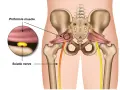 Illustration zeigt das Piriformis-Syndrom: Der Piriformis-Muskel drückt auf den Ischiasnerv.