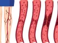 Illustration zeigt gesunde Wade und Blutgefäße mit zunehmender Thrombosebildung. Ein Thrombose Test Wade kann dies aufzeigen.