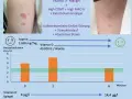 Vitamin D Mangel Symptome bei Erwachsenen: Erfahrungsberichte und Anzeichen