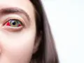 Occhio con congiuntiva arrossata, come se ci fosse un sassolino nell'occhio, che causa irritazione e dolore.