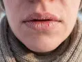 Suche usta, spierzchnięte i popękane, potrzebują natychmiastowej pomocy.
