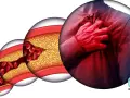 Postępująca choroba wieńcowa: zwężone naczynia krwionośne z cholesterolem i czerwonymi krwinkami, obok mężczyzna trzymający się za serce.