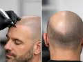 Un hombre recibe micropigmentación capilar para simular cabello. La imagen muestra el proceso y el resultado parcial.