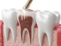 Zabieg stomatologiczny: narzędzie dentystyczne usuwa tkankę z zęba, lecząc zatrucie zęba.
