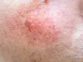 Skóra z widocznymi naczynkami i przebarwieniami, czekająca na retinol efekty.